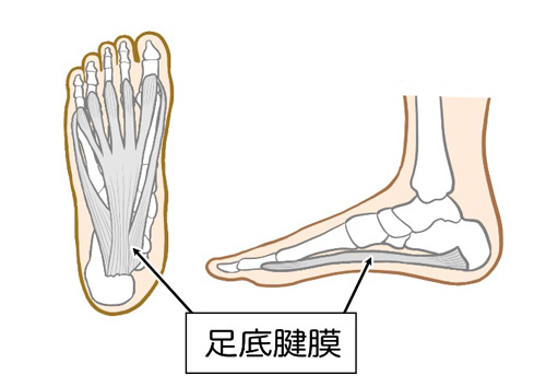 足底腱膜炎（そくていきんまくえん）のイメージ画像