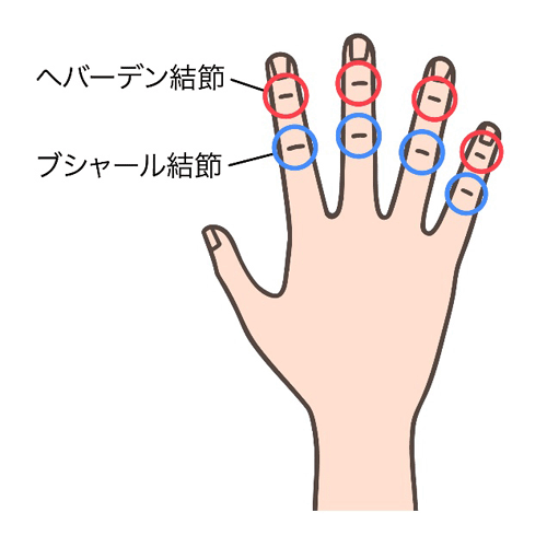 ブシャール結節のイメージ画像