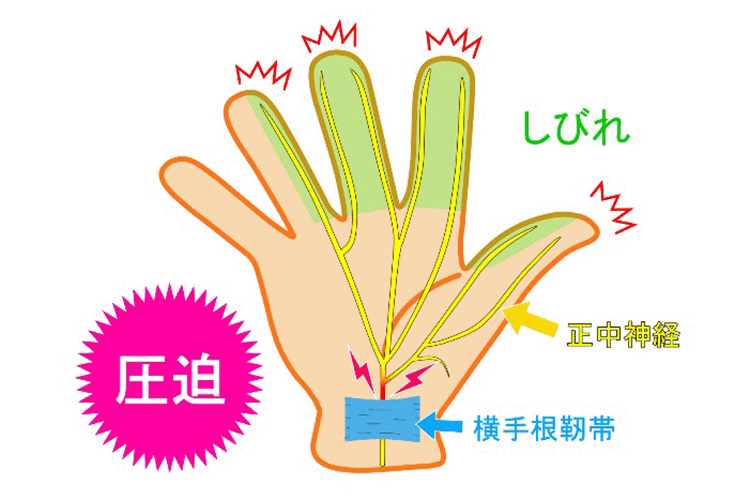 手根管症候群のイメージ画像