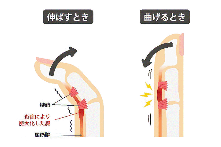 ばね指（弾発指）のイメージ画像