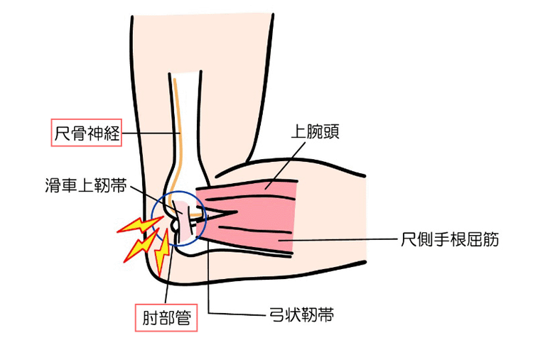 肘部管症候群のイメージ画像