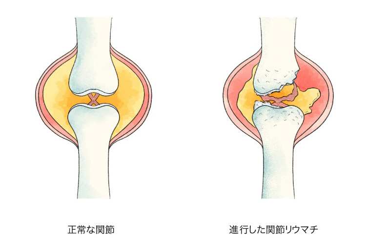 関節リウマチのイメージ画像