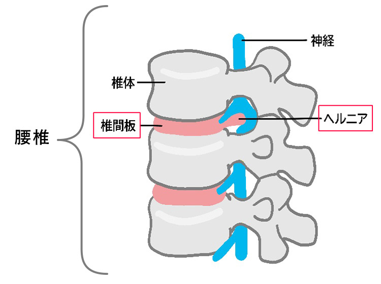 腰椎椎間板ヘルニアのイメージ画像