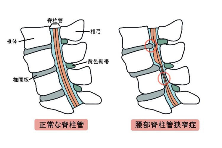腰部脊柱管狭窄症のイメージ画像
