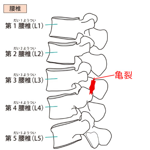 腰椎分離症のイメージ画像