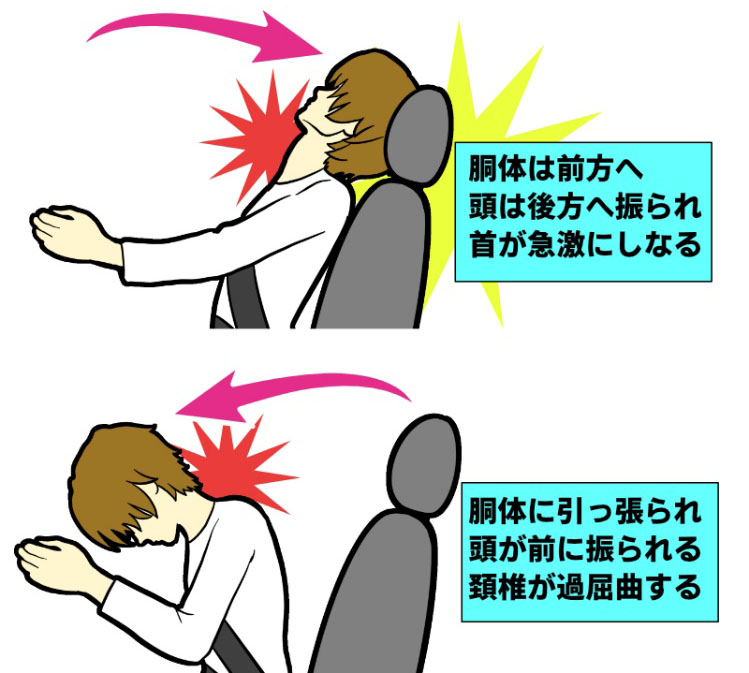 むち打ち症（頸椎捻挫）のイメージ画像
