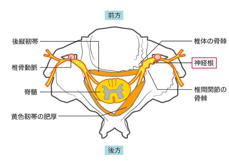 頸椎症性神経根症のイメージ画像
