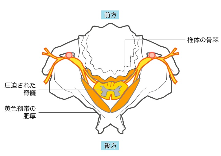 頸椎症性脊髄症のイメージ画像