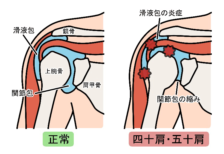 五十肩（肩関節周囲炎：かたかんせつしゅういえん）のイメージ画像